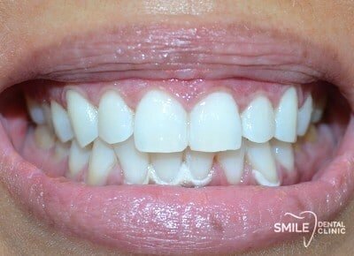 teeth whitening coupon dubai